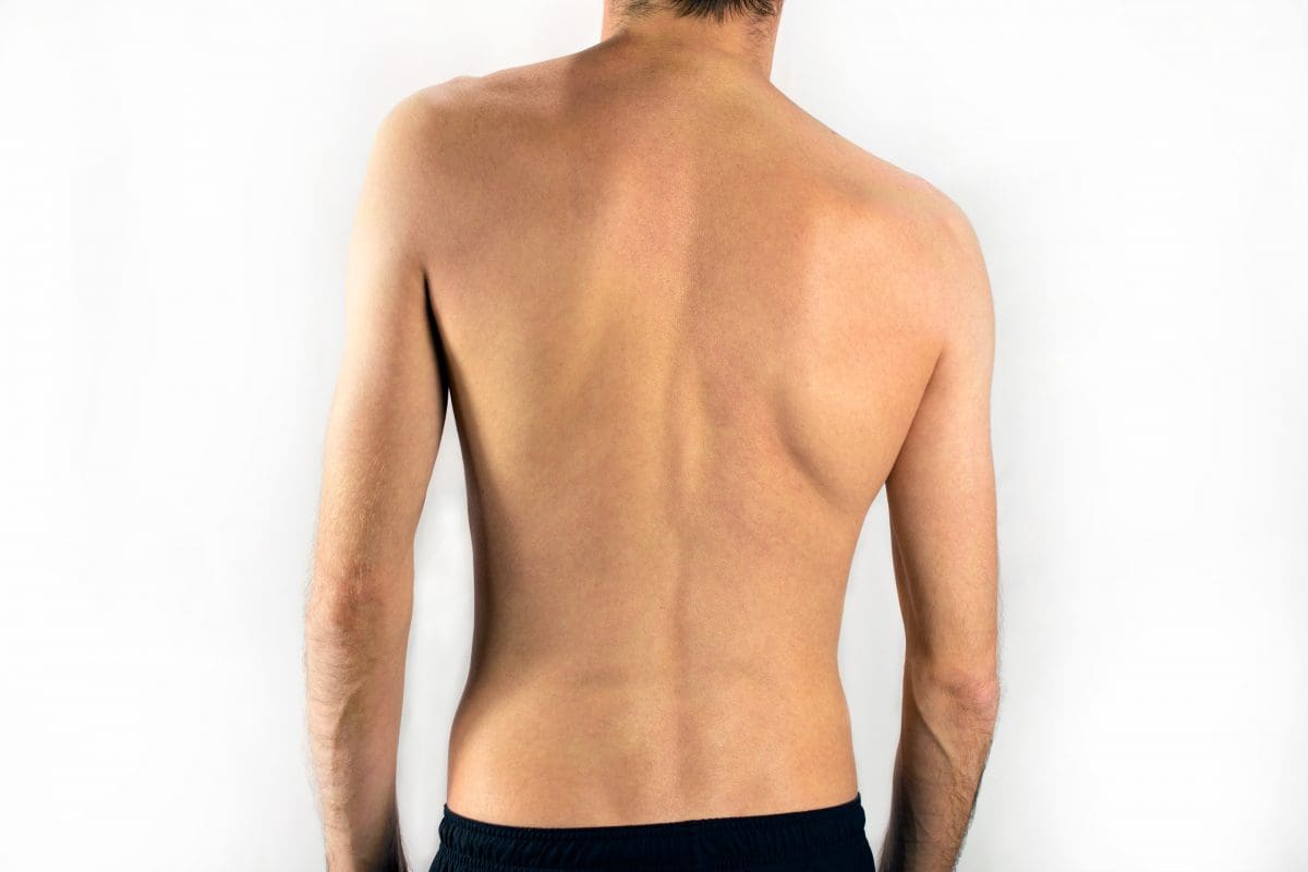 scoliosis