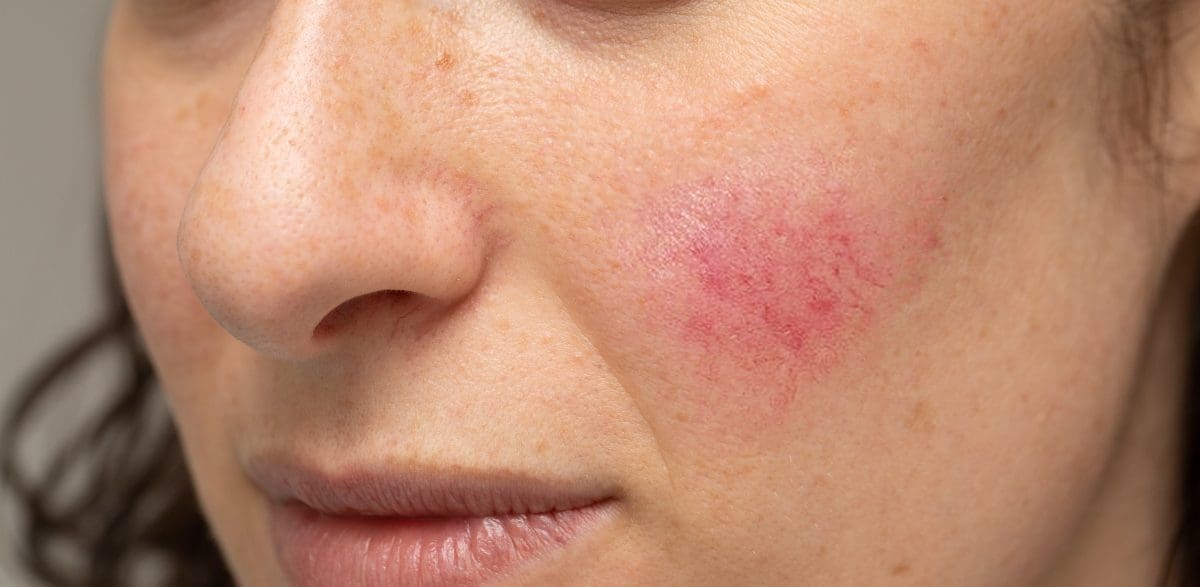 Rosacea