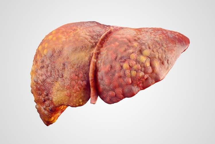 Liver cirrhosis