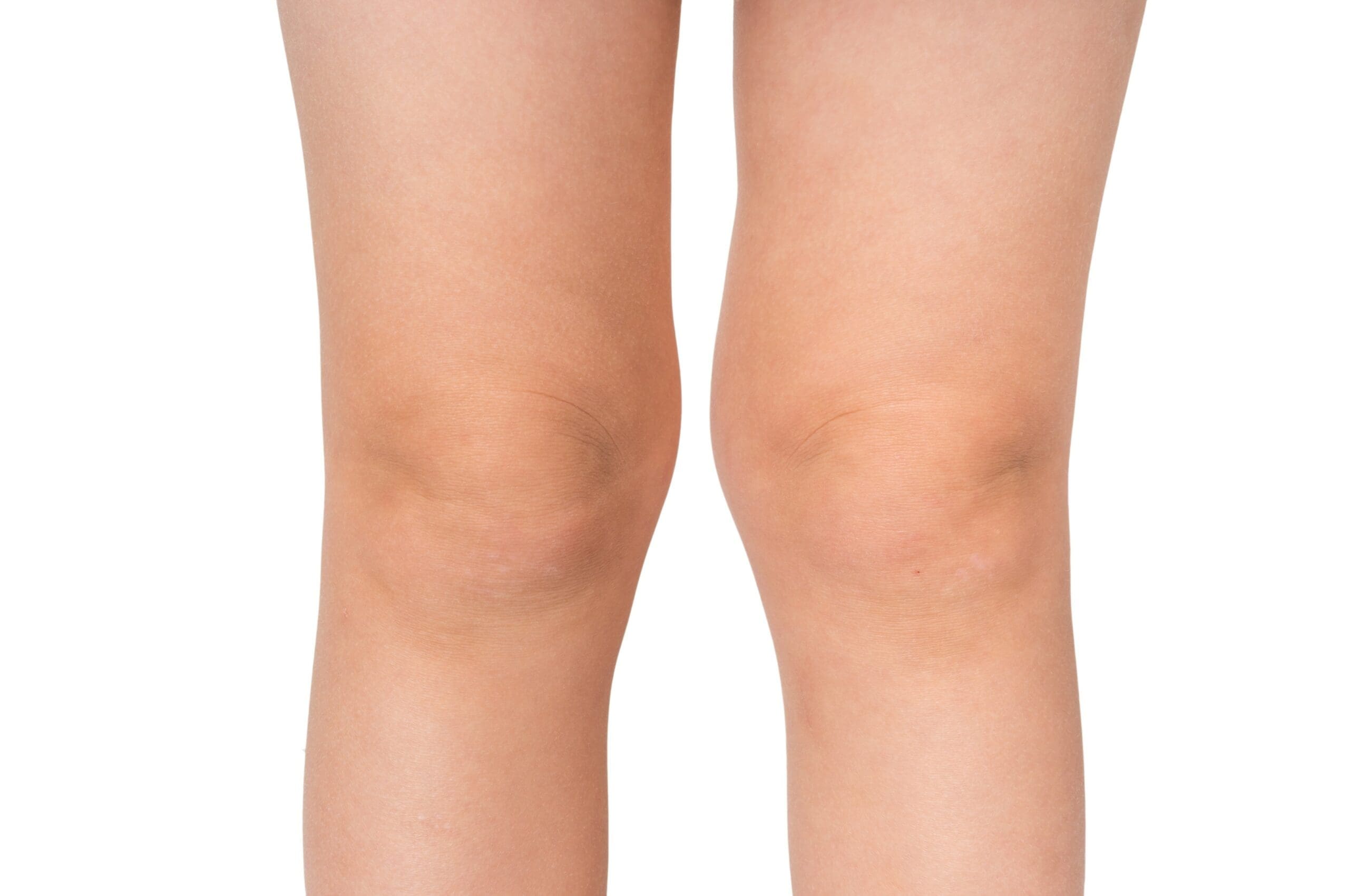Knock knees