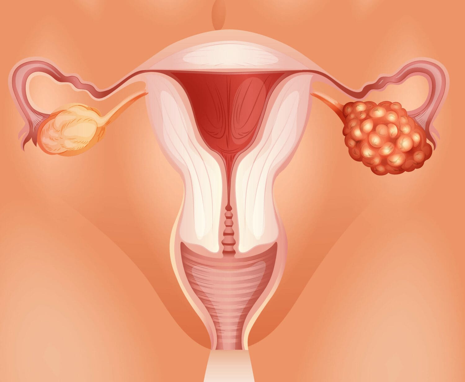 Ovarian cancer: treatment options