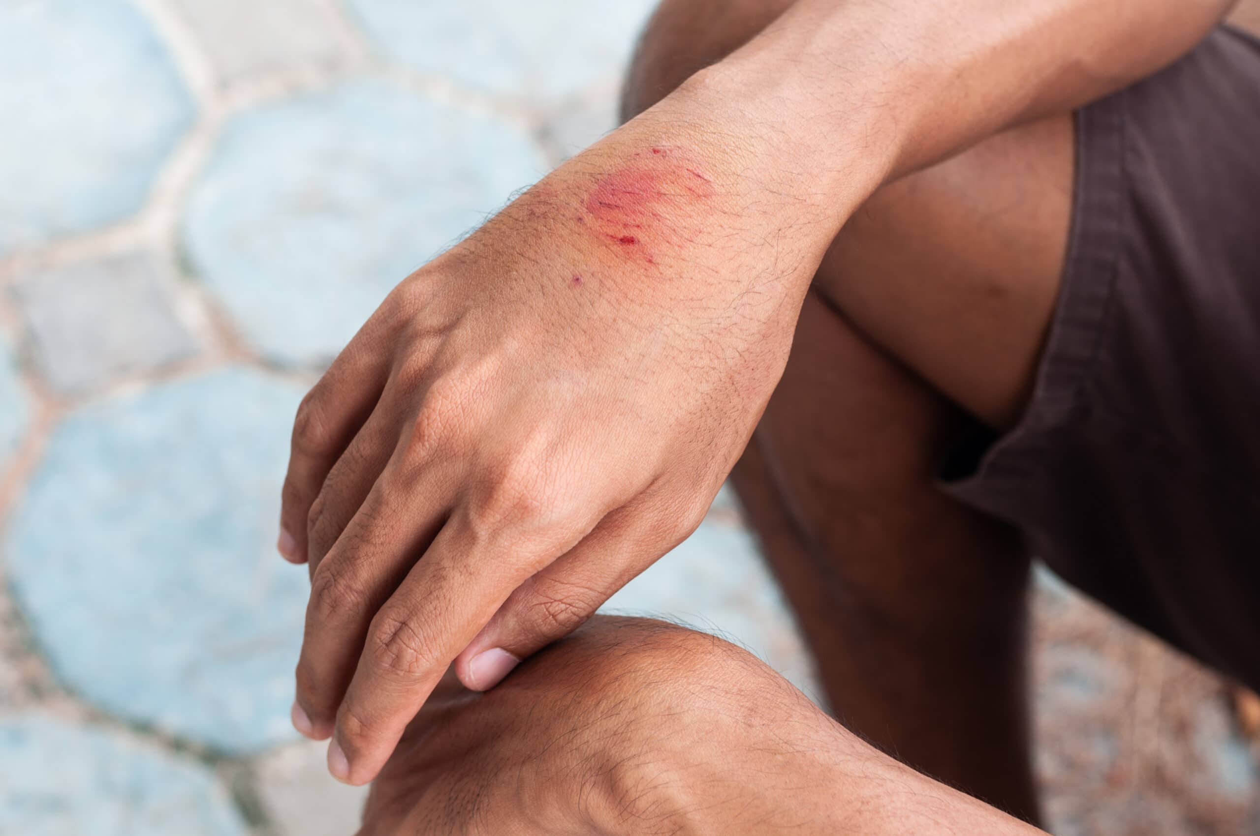 Rabies: information for travellers