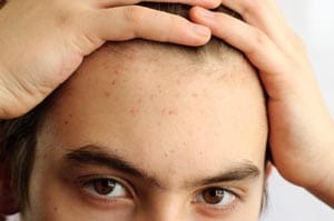 Acne overview