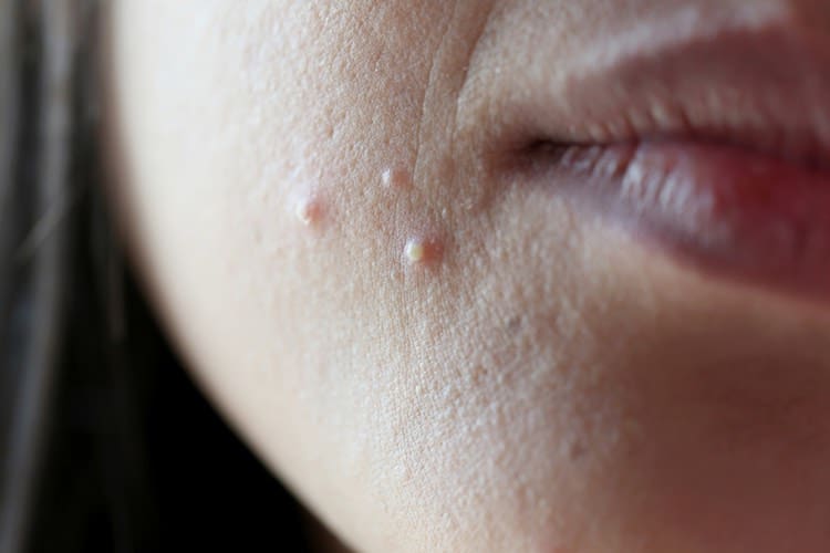 Acne: self-care