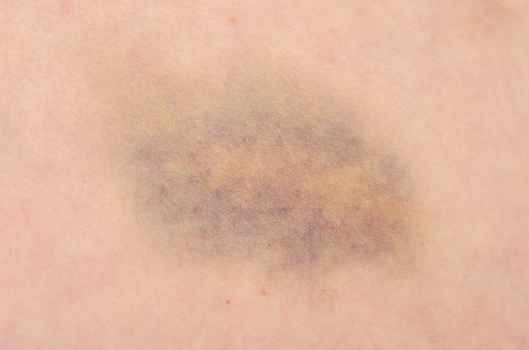 bruise