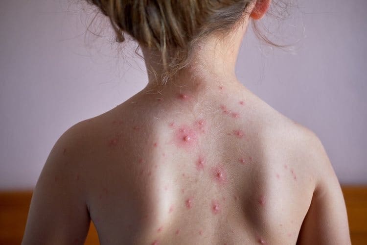 Chickenpox