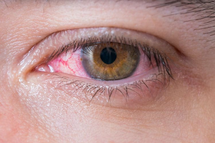 conjunctivitis_750