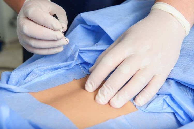 Epidurals