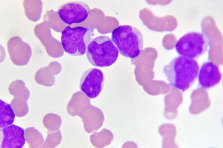 Leukaemia