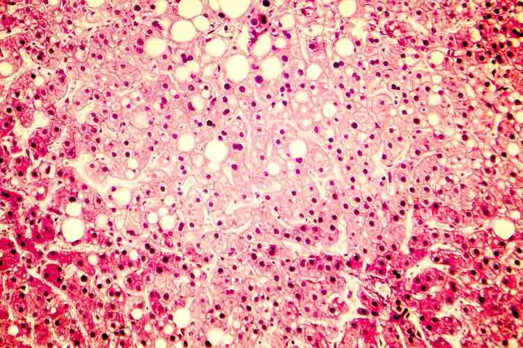 Liver biopsy