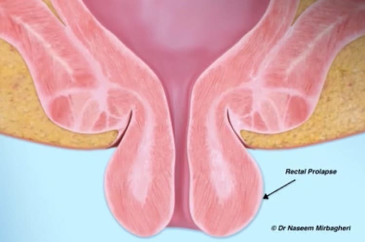 Video: Rectal prolapse – Dr Naseem