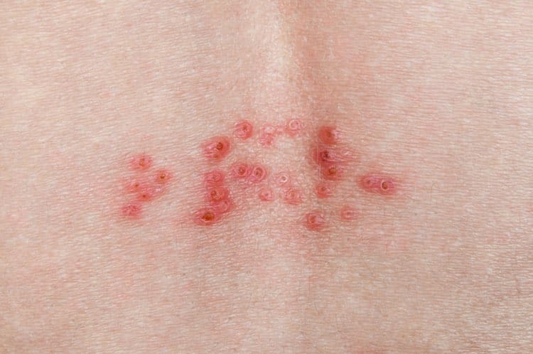 shingles_self_care