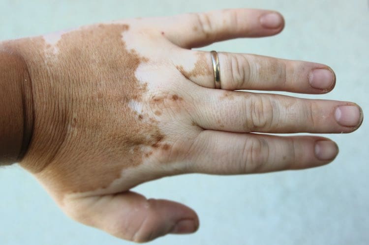 vitiligo