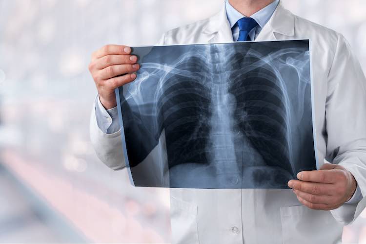 lung cancer x ray