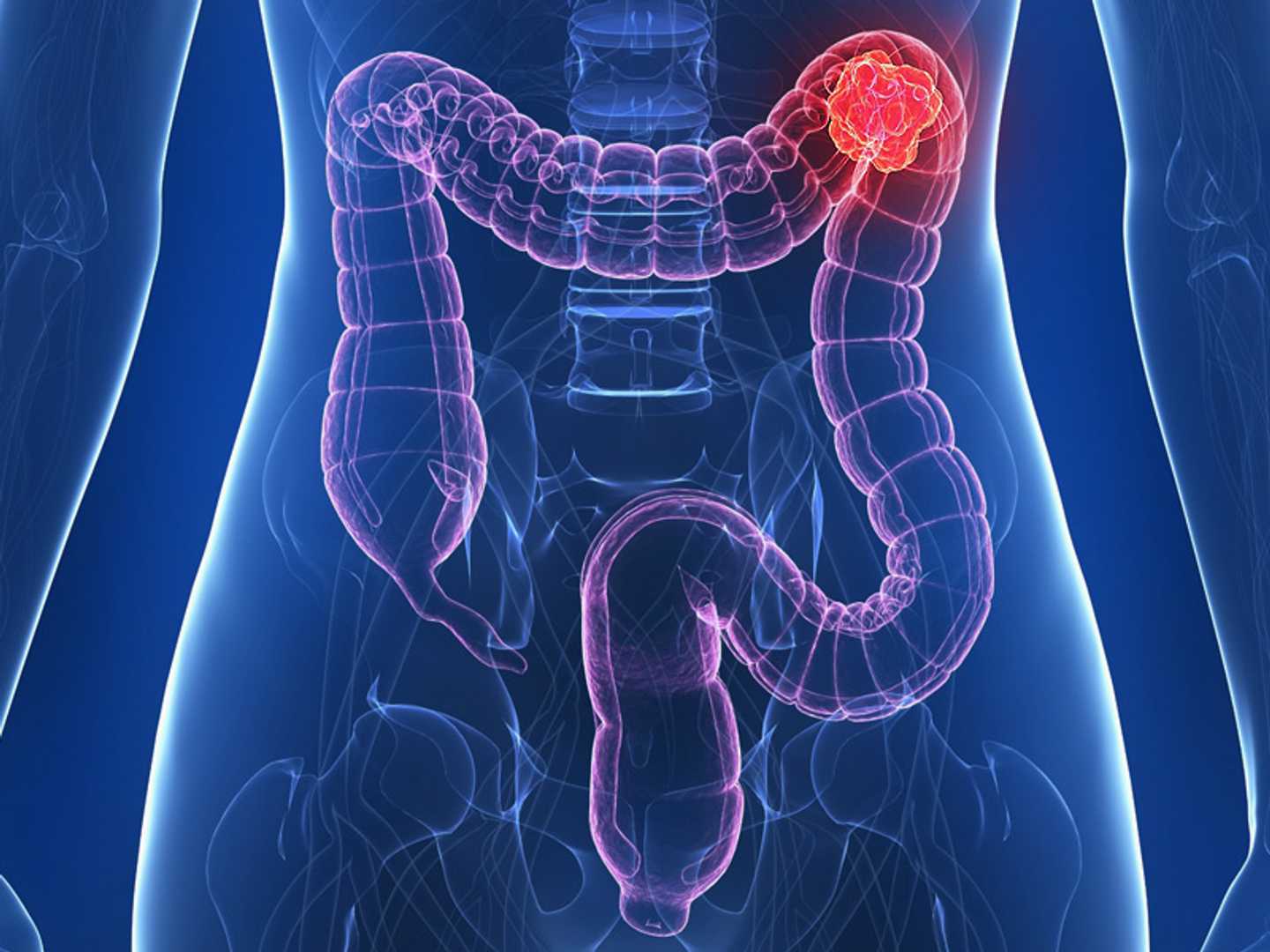 Bowel Cancer Awareness Month