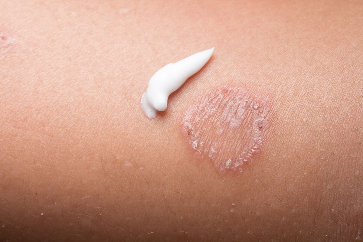 A close-up image of ring worm infection