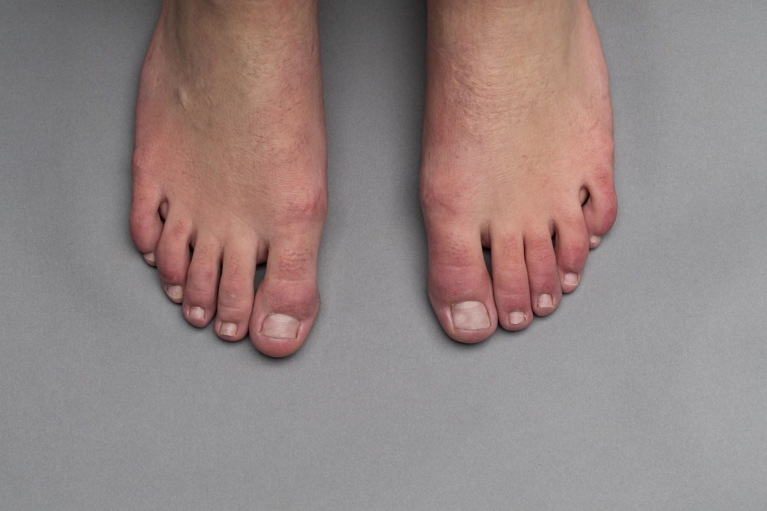 What are COVID toes?
