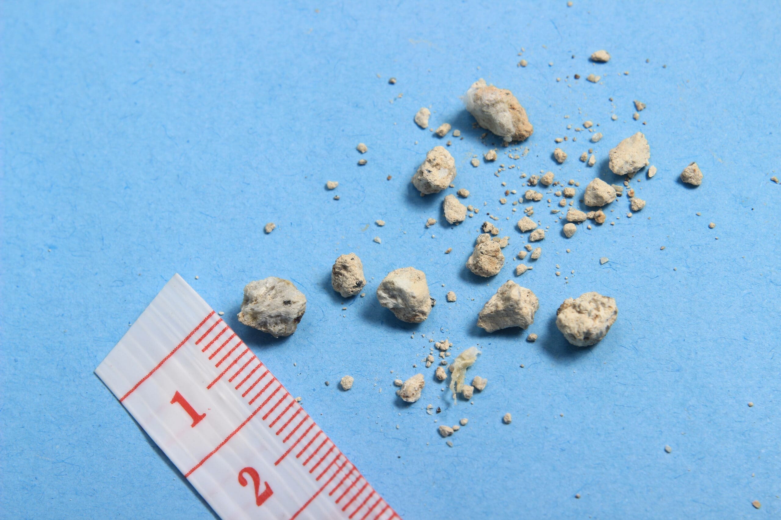Kidney stones