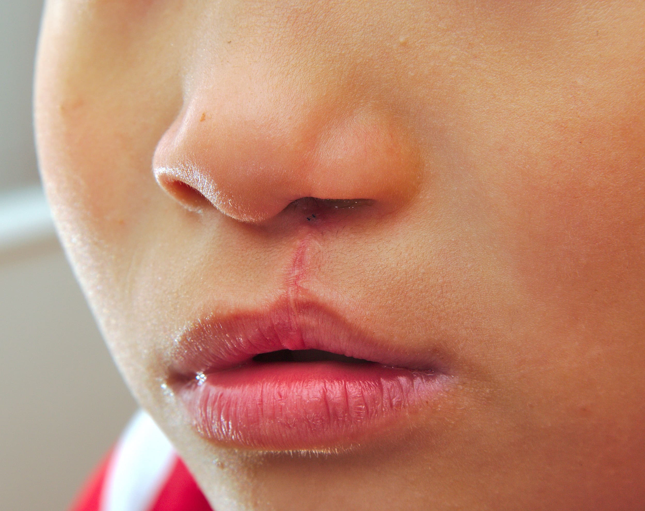 What is a Cleft Palate and Who Does it Effect?