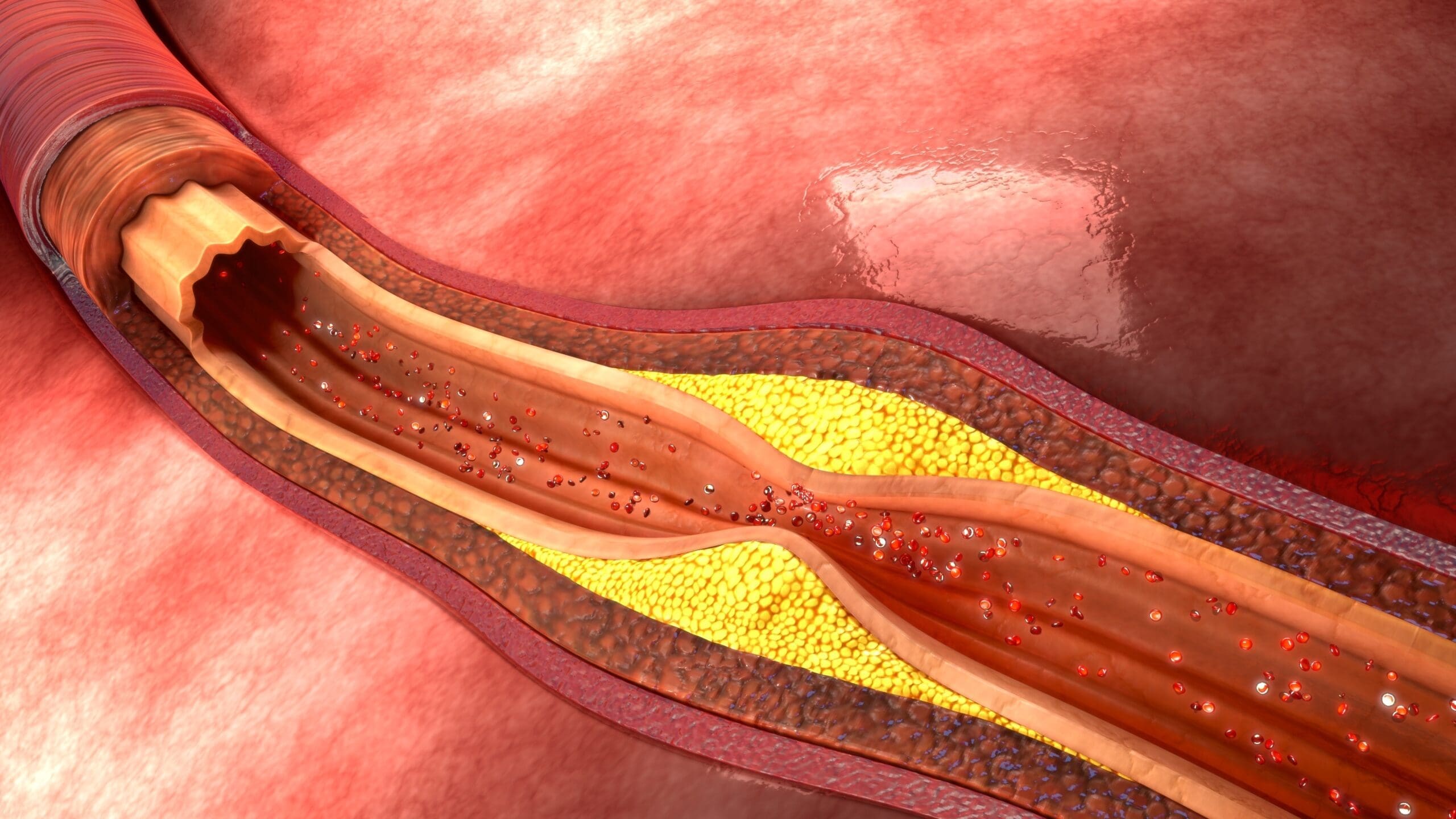 Reversing Plaque Build up in Your Heart – Dr. Norman Swan