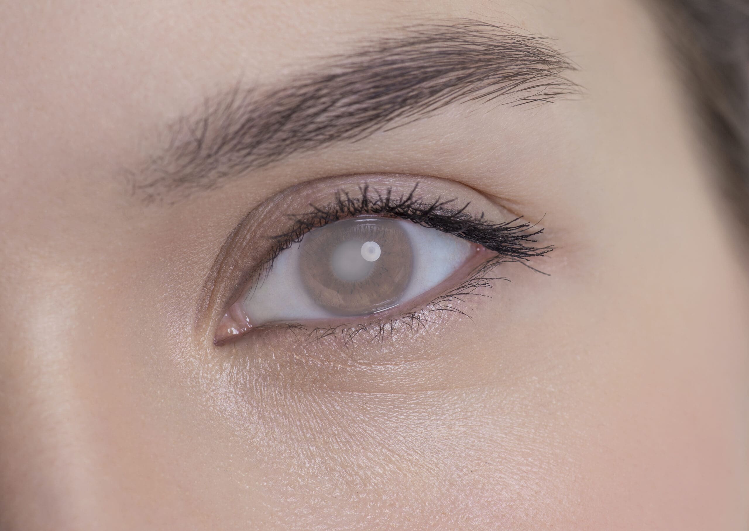 Cataracts