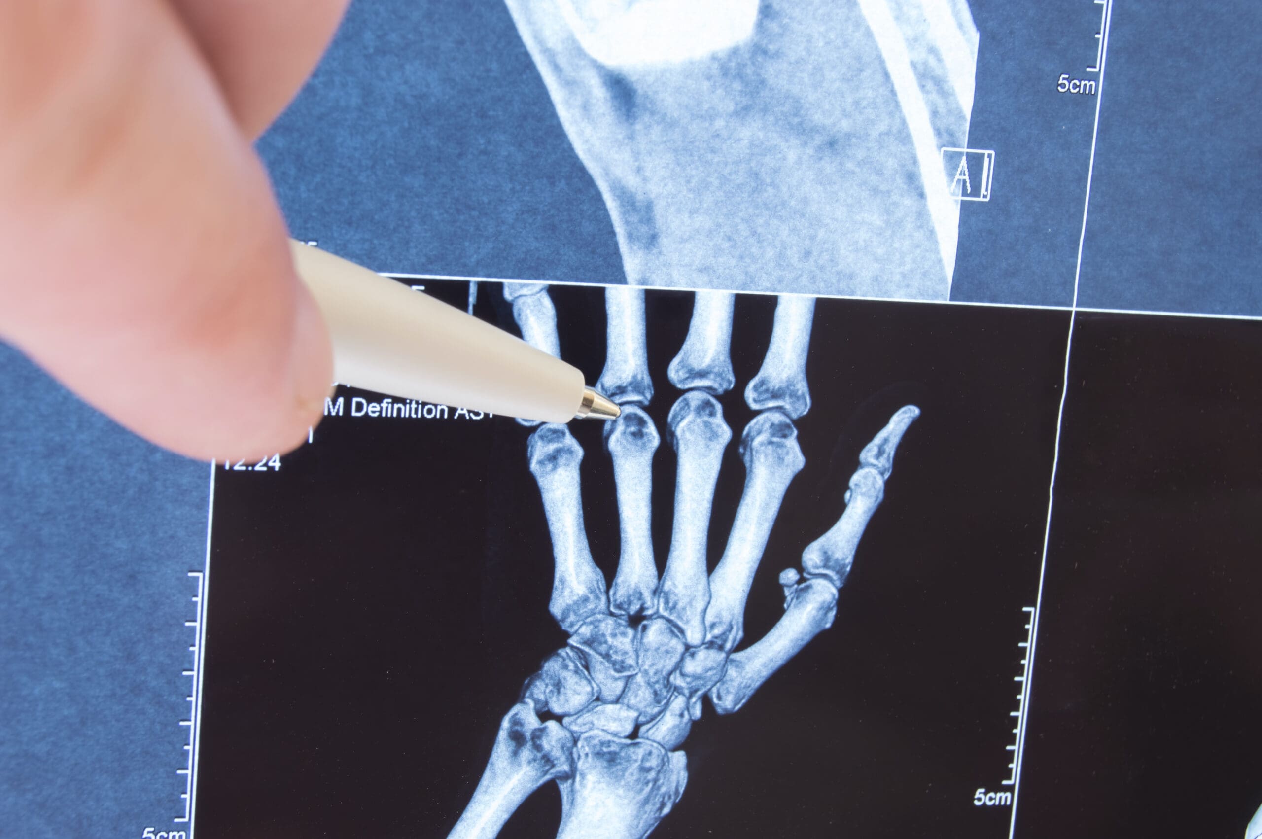 Juvenile Arthritis