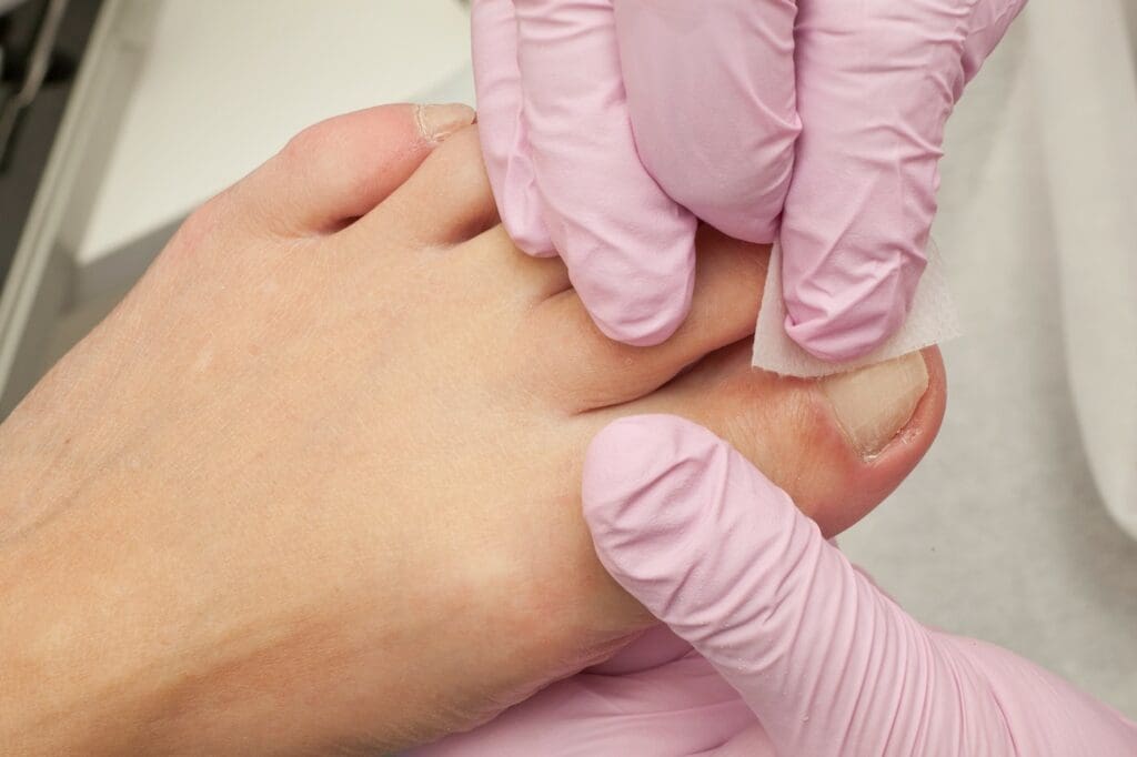 ingrown toenail