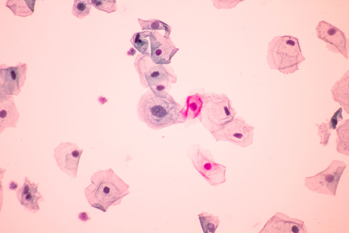 Abnormal squamous cells, HPV from cervical screening test