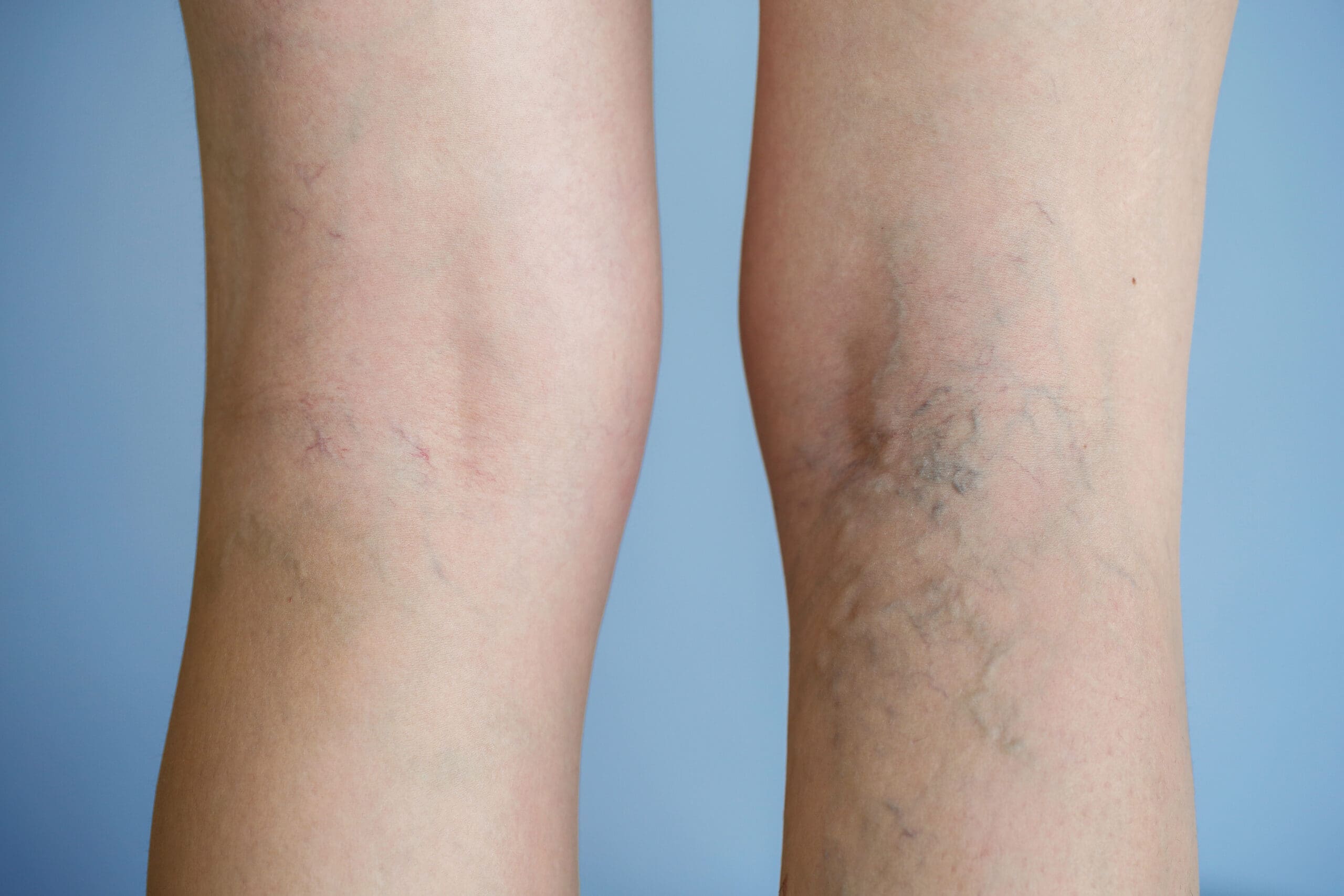 Varicose veins