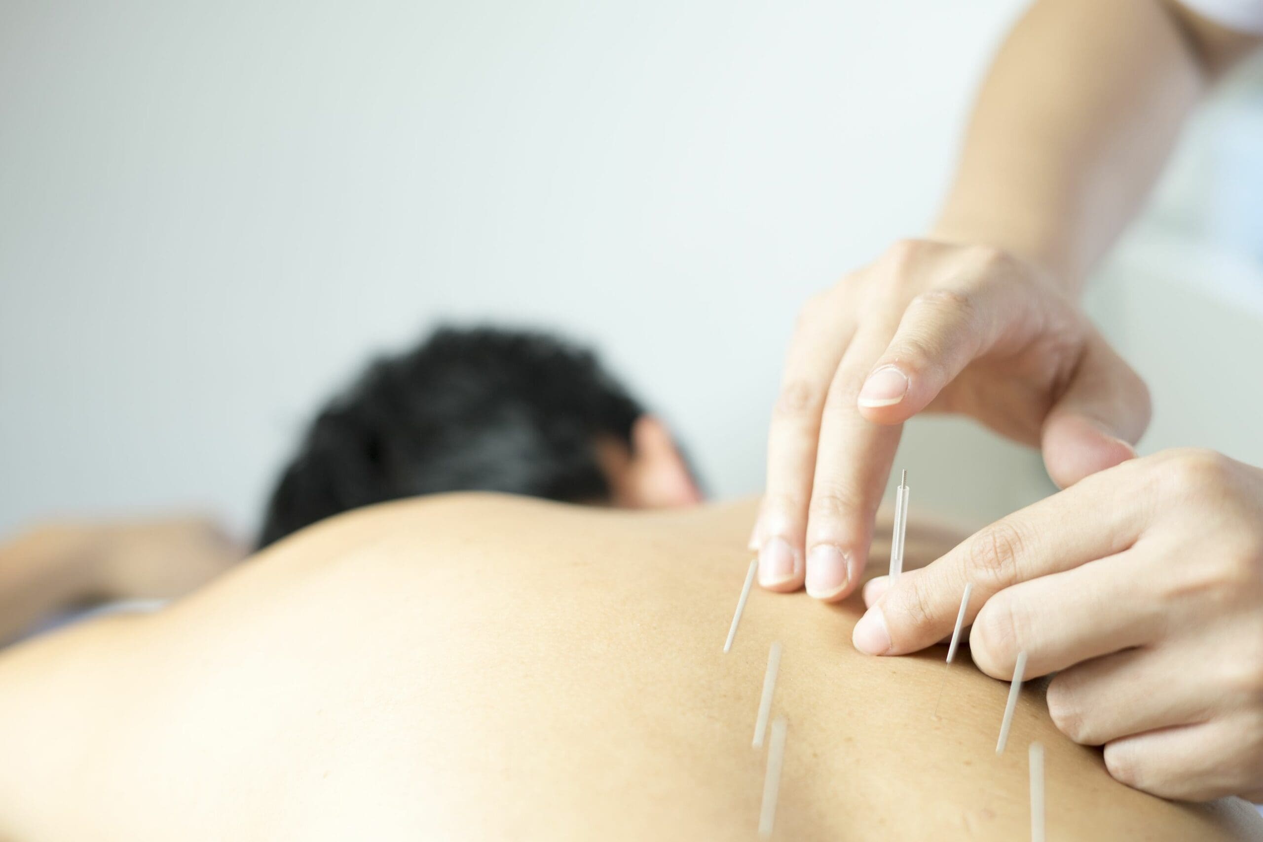 Does acupuncture help hay fever symptoms?
