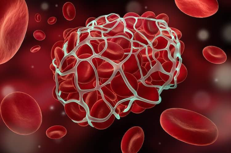 Video: Blood clots – reducing the risk