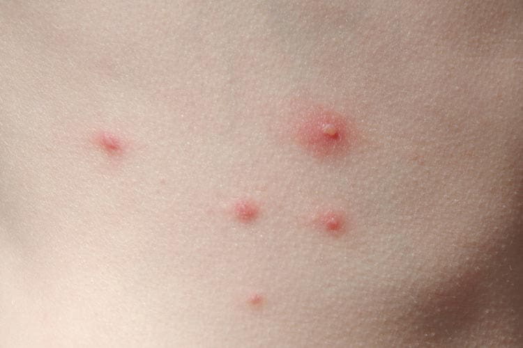Childhood rashes