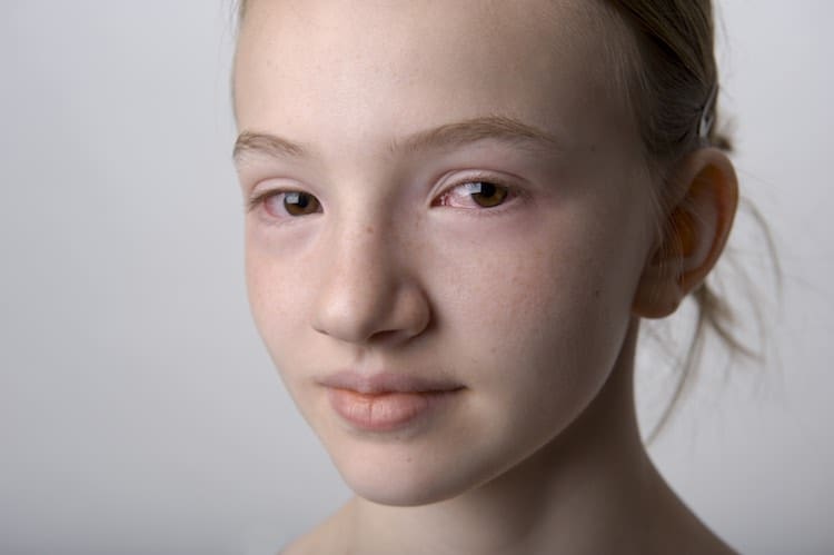Symptoms and causes of Conjunctivitis
