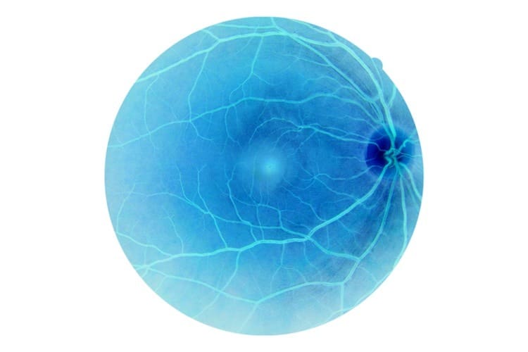 Retinal detachment
