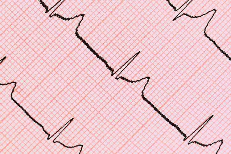 ecg