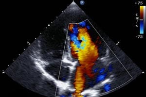 echocardiogram_300