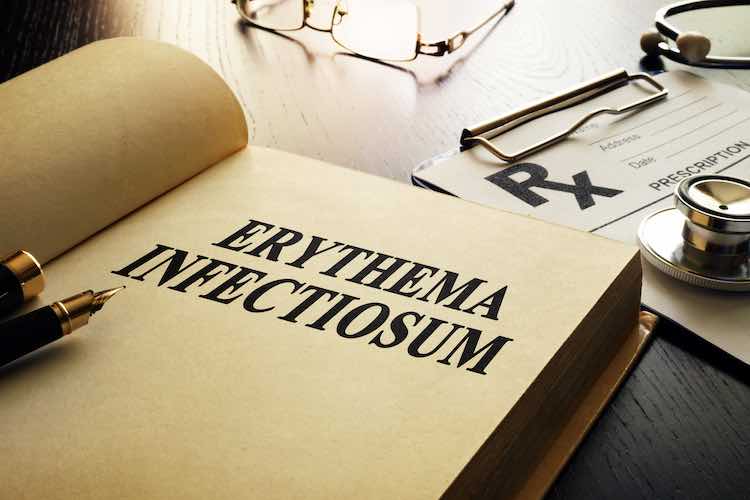 Fifth disease