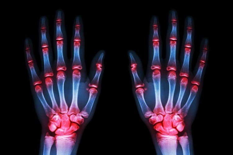Rheumatoid arthritis