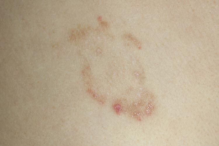 ringworm lesions look like a ring, or worms under the skin ringworm lesions
