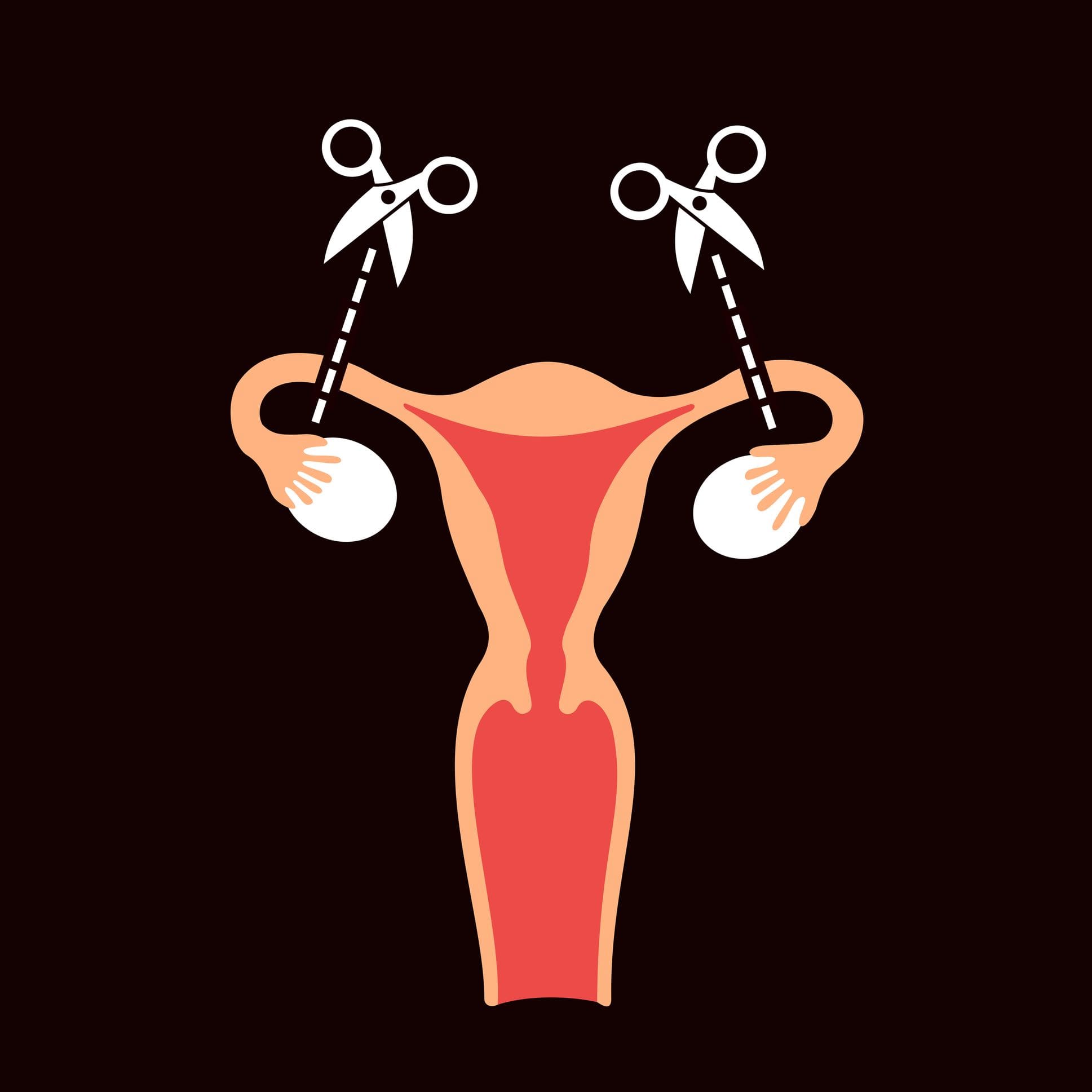 What is female surgical sterilisation