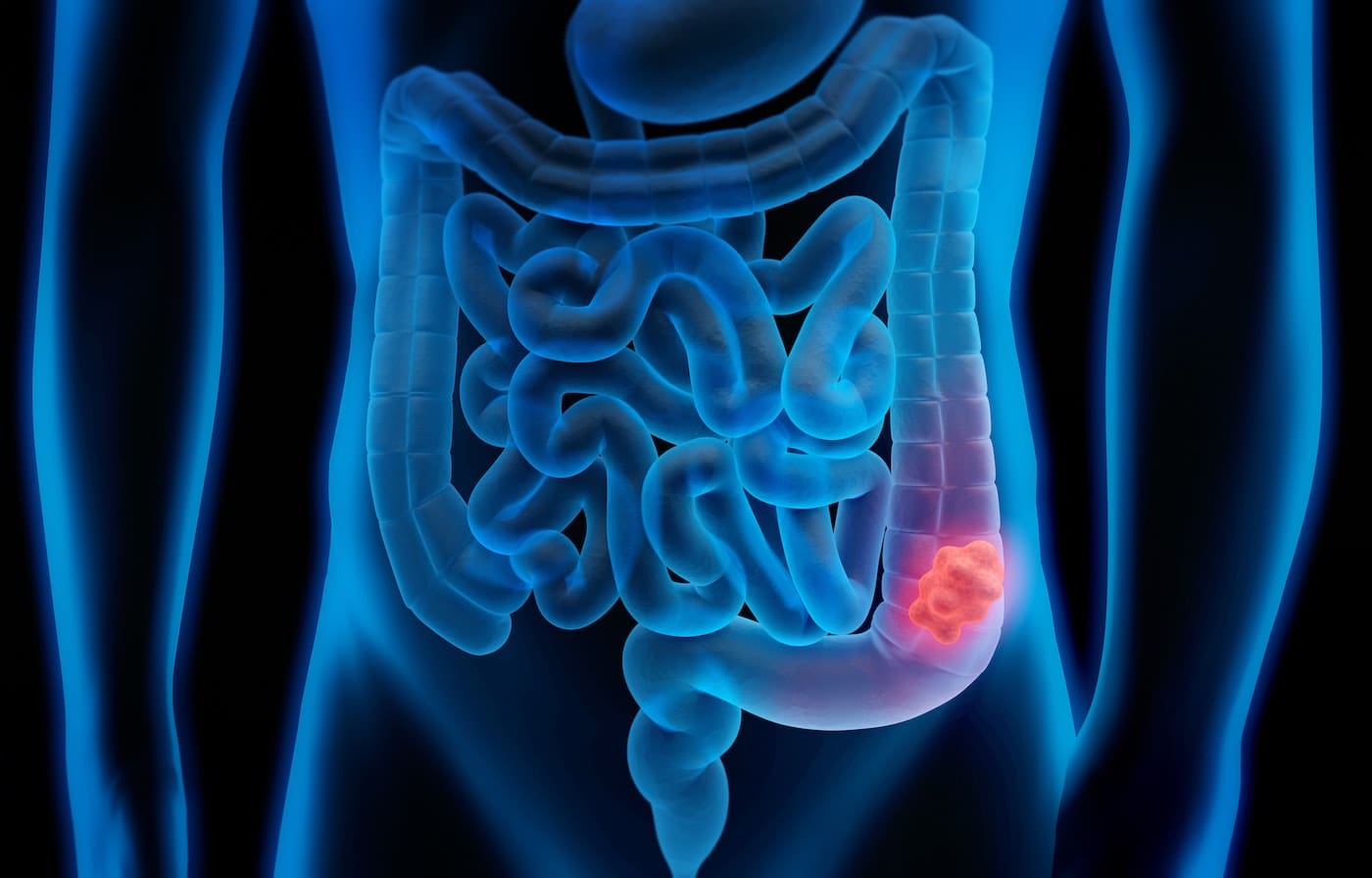 Video: Bowel Cancer Awareness Month
