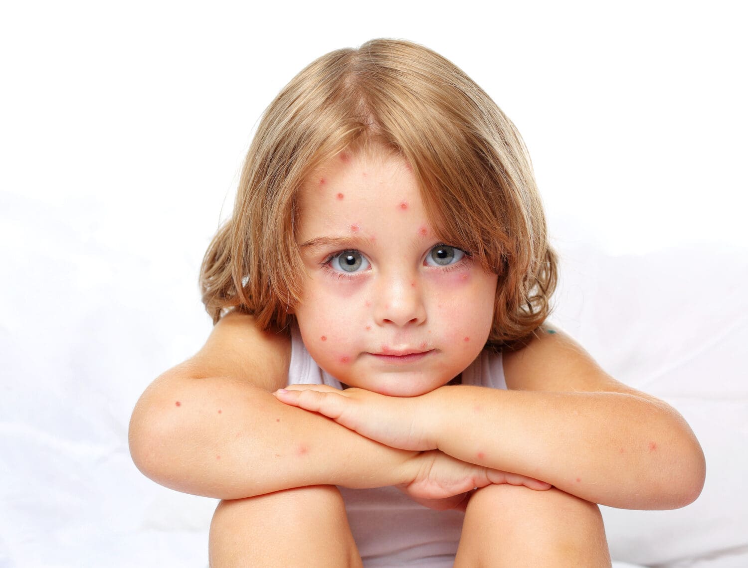 Does Smallpox Still Exist and What is It? Dr. Norman Swan
