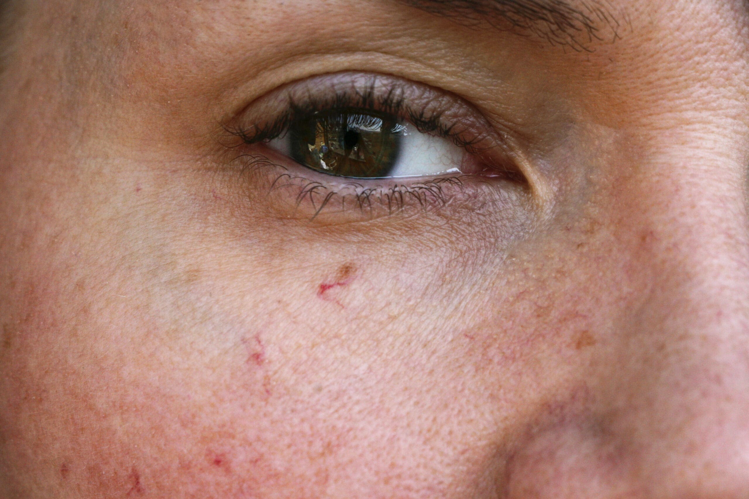 What is Hereditary Haemorrhagic Telangiectasia?