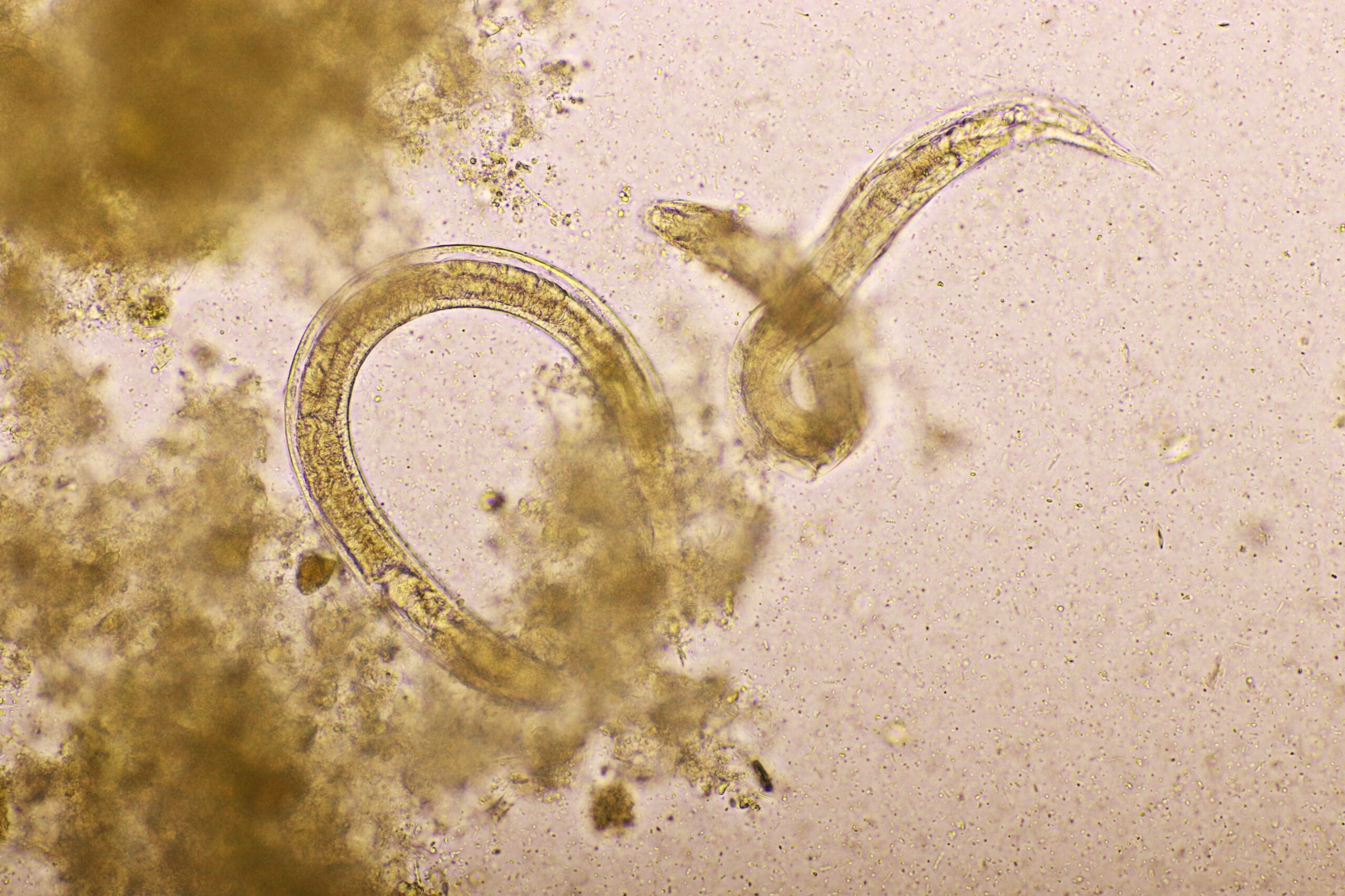 How do you catch Pinworms? – Dr. Norman Swan
