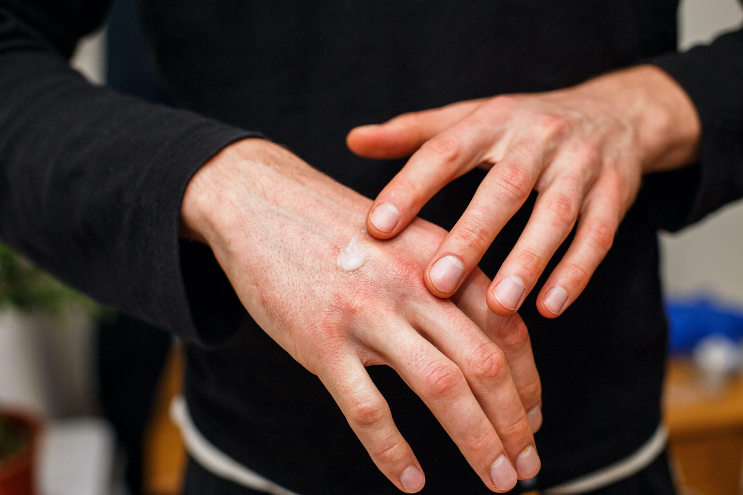 Contact Dermatitis