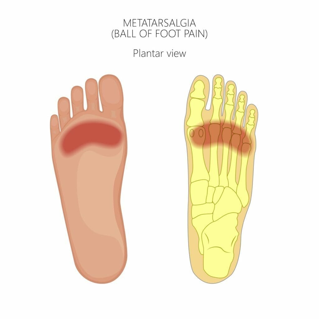 metatarsalgia pain diagram
