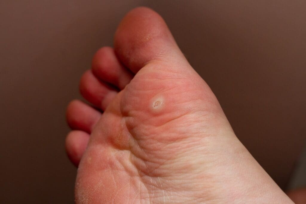 plantar wart