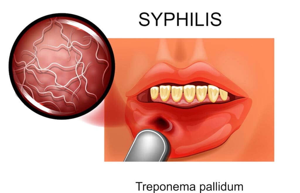 syphilis chancre